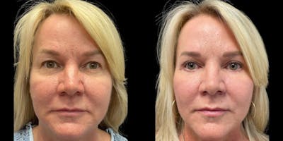 Blepharoplasty Before & After Gallery - Patient 272769 - Image 1