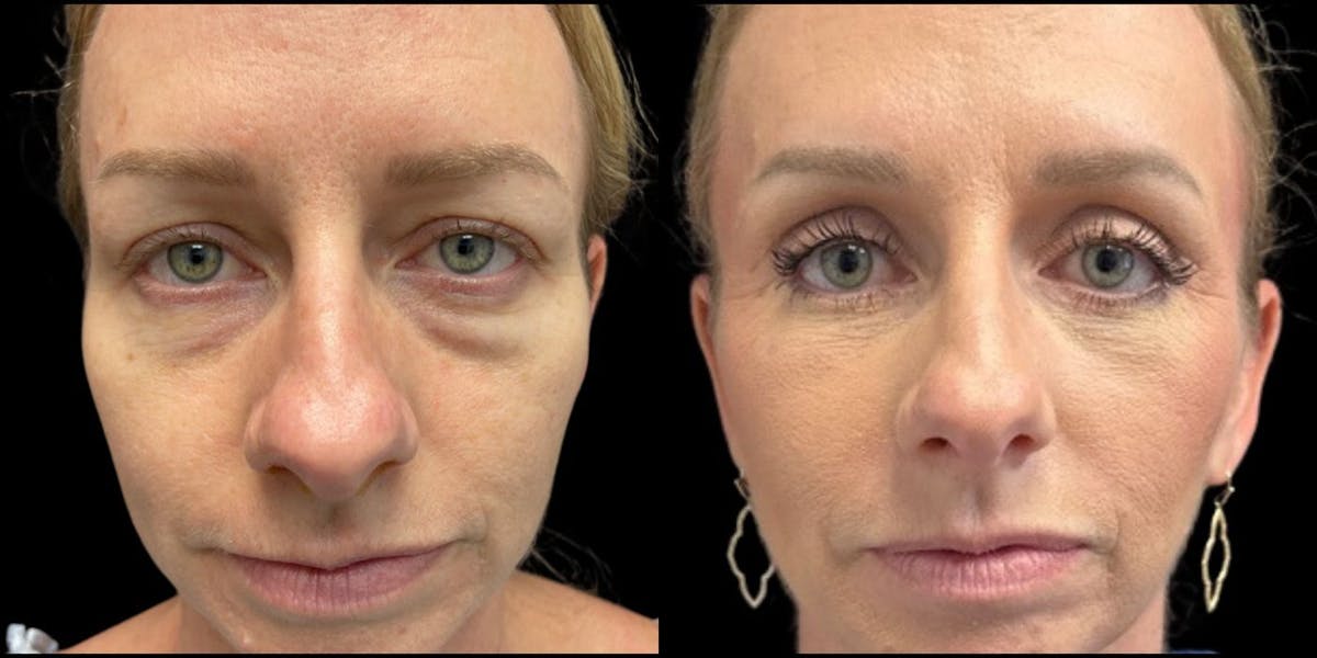 Blepharoplasty Before & After Gallery - Patient 388098 - Image 1