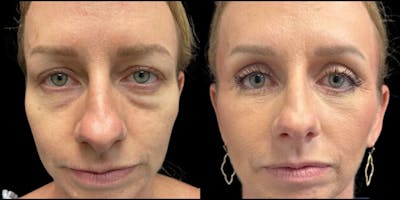 Blepharoplasty Before & After Gallery - Patient 388098 - Image 1