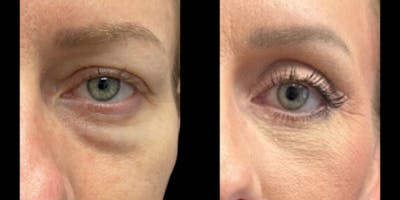 Blepharoplasty Before & After Gallery - Patient 387163 - Image 1