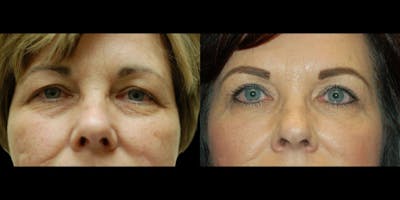 Blepharoplasty Before & After Gallery - Patient 259161 - Image 1