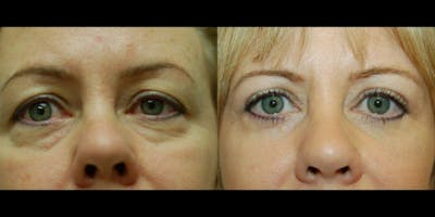 Blepharoplasty Before & After Gallery - Patient 380958 - Image 1