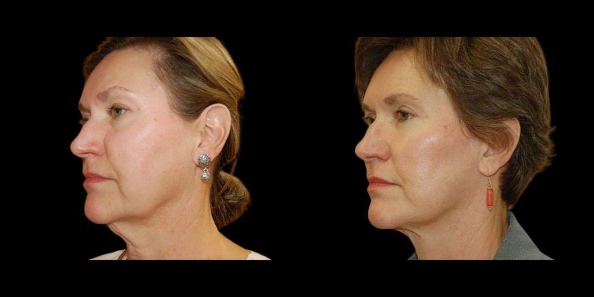 Blepharoplasty Before & After Gallery - Patient 143152 - Image 1