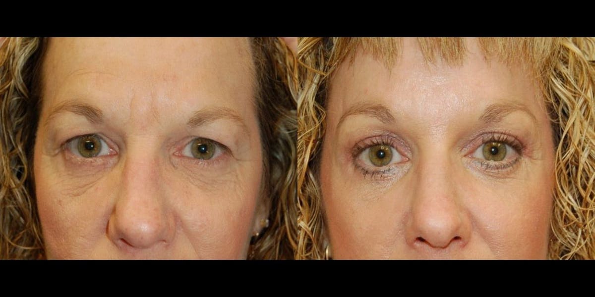 Blepharoplasty Before & After Gallery - Patient 186393 - Image 1