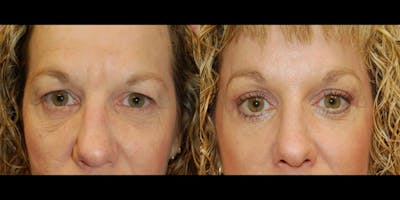 Blepharoplasty Before & After Gallery - Patient 186393 - Image 1