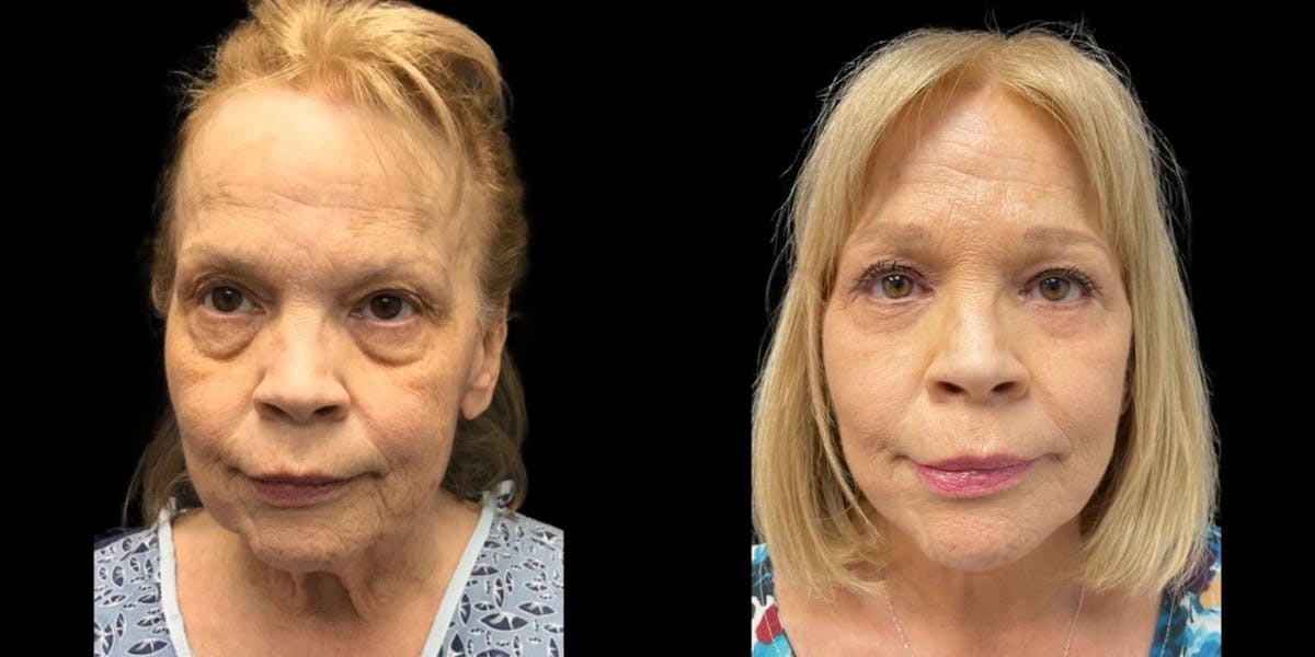 Facelift Before & After Gallery - Patient 186729 - Image 1