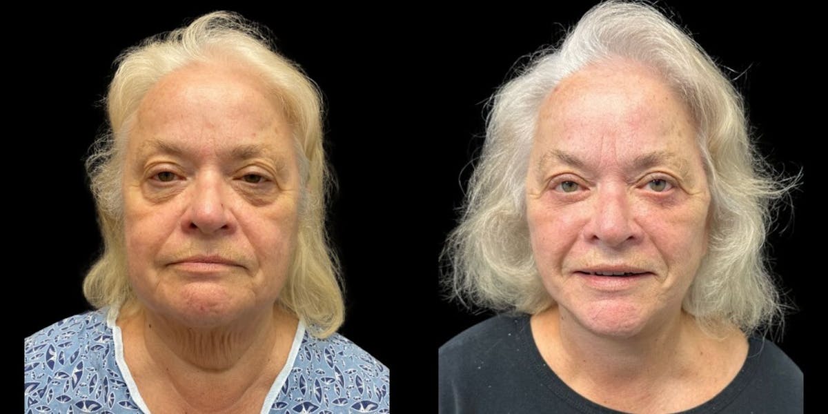Facelift Before & After Gallery - Patient 586040 - Image 1
