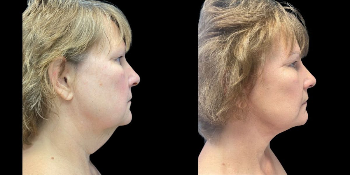 Facelift Before & After Gallery - Patient 201010 - Image 1
