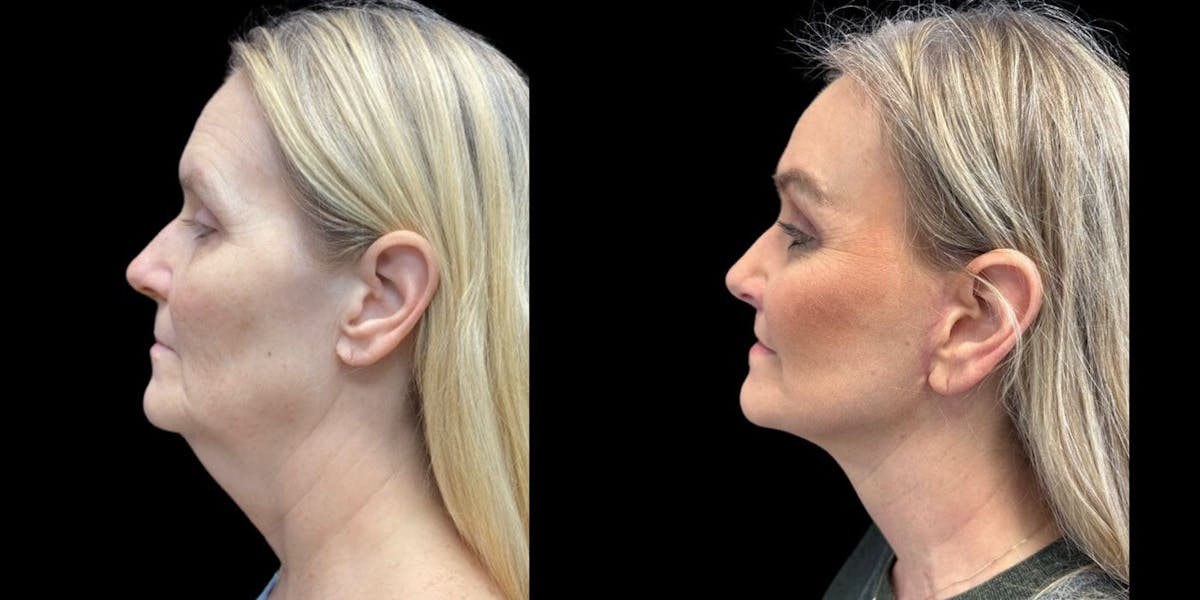 Facelift Before & After Gallery - Patient 795762 - Image 1