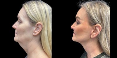 Facelift Before & After Gallery - Patient 795762 - Image 1