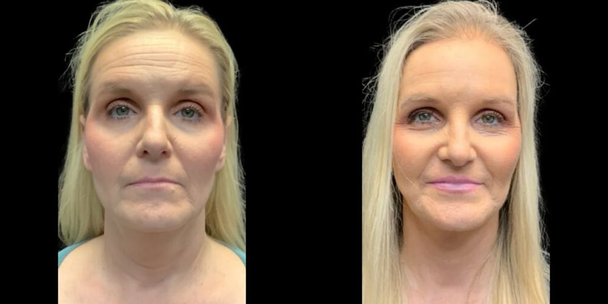 Facelift Before & After Gallery - Patient 548944 - Image 1