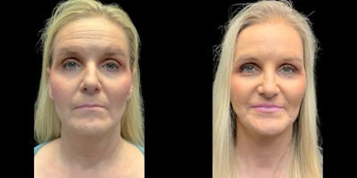 Facelift Before & After Gallery - Patient 548944 - Image 1
