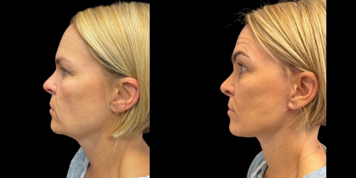 Facelift Before & After Gallery - Patient 396291 - Image 1