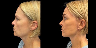 Facelift Before & After Gallery - Patient 396291 - Image 1