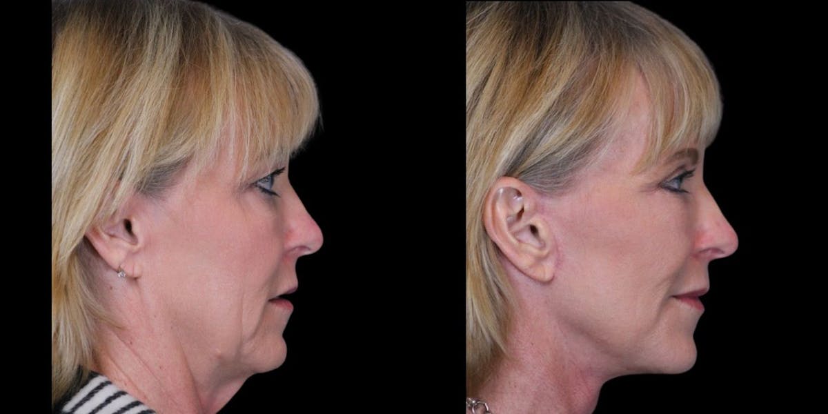 Facelift Before & After Gallery - Patient 264031 - Image 1