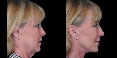 Facelift Before & After Gallery - Patient 264031 - Image 1