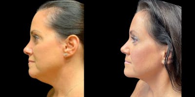 FaceTITE Before & After Gallery - Patient 271801 - Image 1