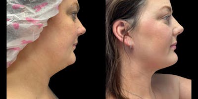 FaceTITE Before & After Gallery - Patient 536812 - Image 1