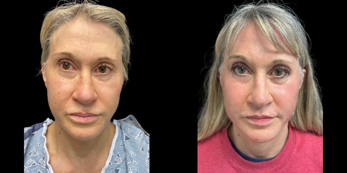 Laser Skin Resurfacing Before & After Gallery - Patient 155581 - Image 1