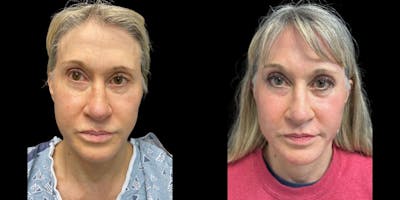 Laser Skin Resurfacing Before & After Gallery - Patient 155581 - Image 1