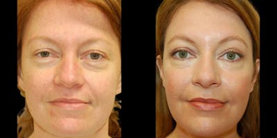Laser Skin Resurfacing Before & After Gallery - Patient 348737 - Image 1