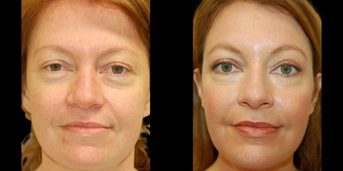 Laser Skin Resurfacing Before & After Gallery - Patient 348737 - Image 1