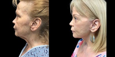 Neck Lift Before & After Gallery - Patient 273814 - Image 1