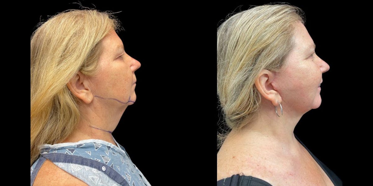 Neck Lift Before & After Gallery - Patient 109903 - Image 1