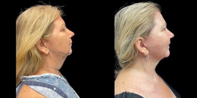 Neck Lift Before & After Gallery - Patient 109903 - Image 1