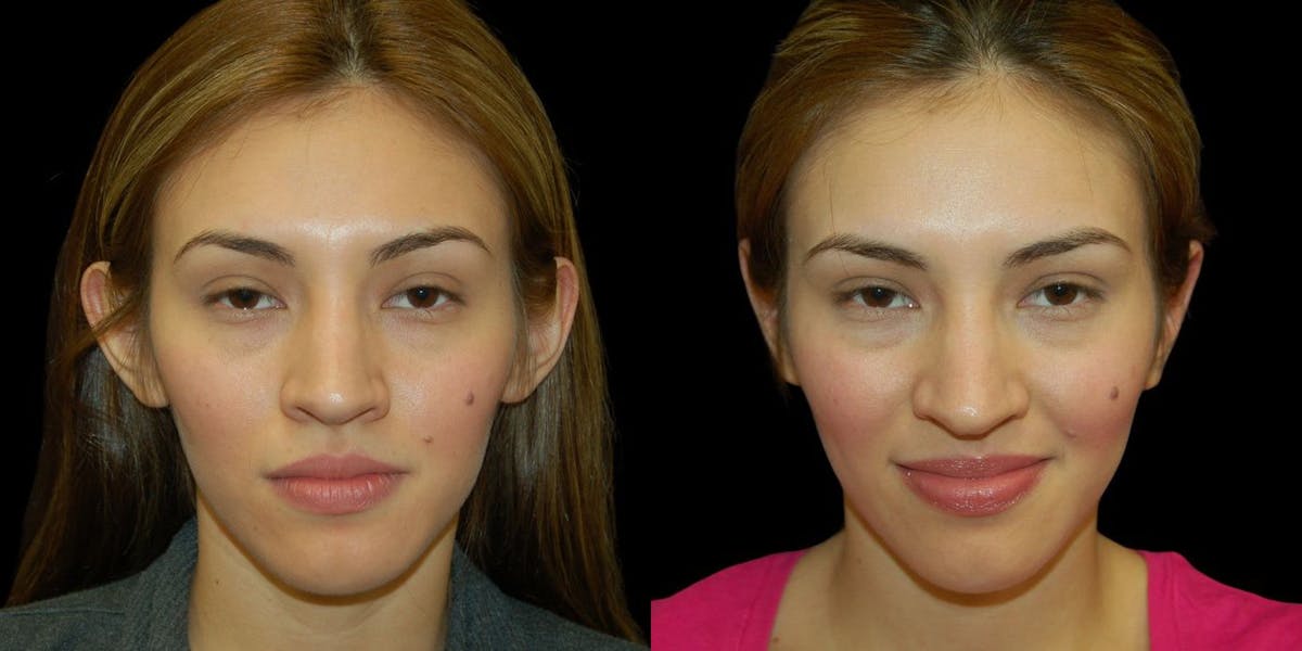 Otoplasty Before & After Gallery - Patient 363634 - Image 1