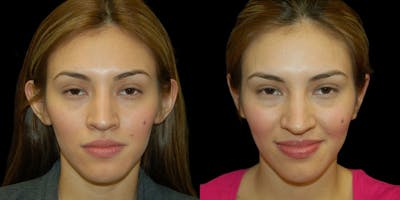 Otoplasty Before & After Gallery - Patient 363634 - Image 1