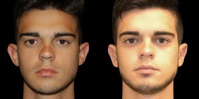 Otoplasty Before & After Gallery - Patient 425215 - Image 1