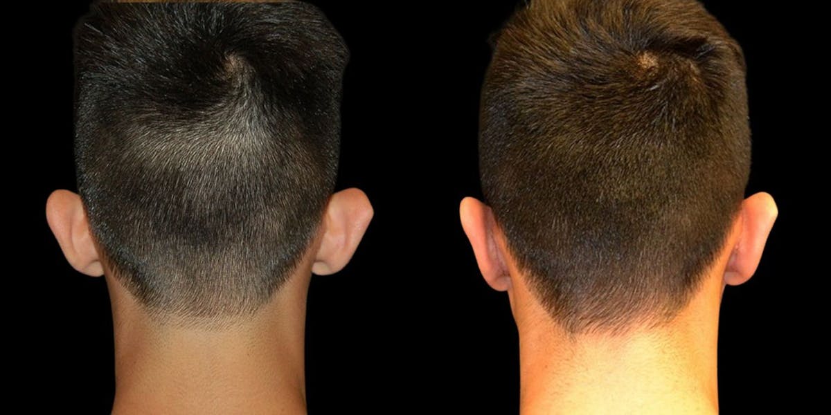 Otoplasty Before & After Gallery - Patient 109137 - Image 1