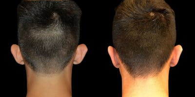 Otoplasty Before & After Gallery - Patient 109137 - Image 1