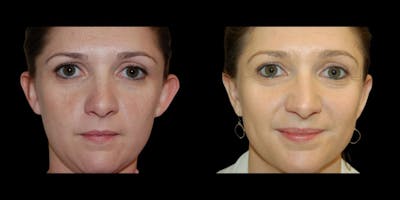 Otoplasty Before & After Gallery - Patient 591428 - Image 1