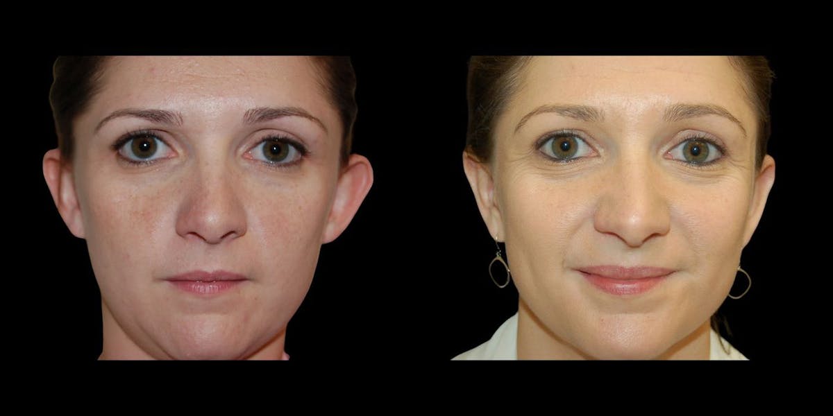 Otoplasty Before & After Gallery - Patient 591428 - Image 1