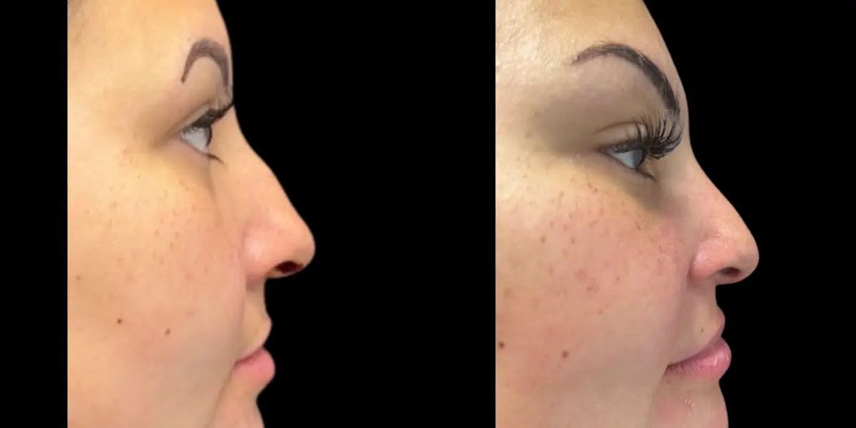 Rhinoplasty Before & After Gallery - Patient 409308 - Image 1