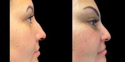 Rhinoplasty Before & After Gallery - Patient 409308 - Image 1