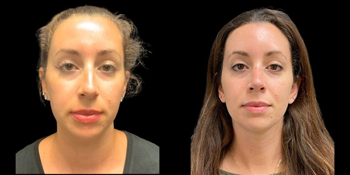 Rhinoplasty Before & After Gallery - Patient 193148 - Image 1