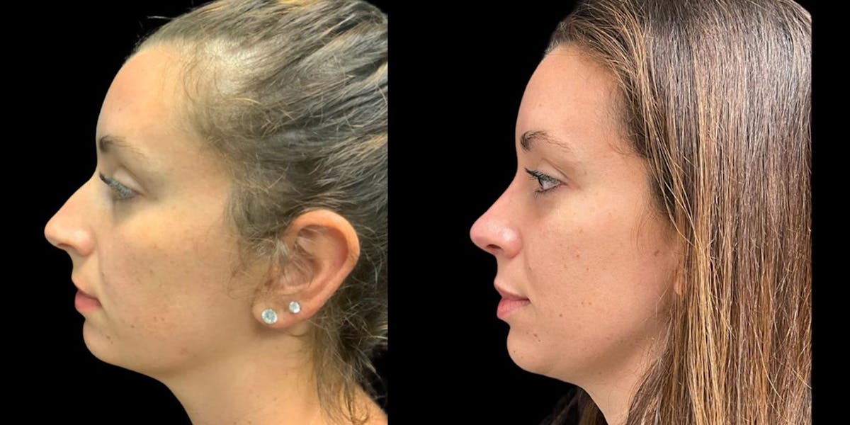 Rhinoplasty Before & After Gallery - Patient 914993 - Image 1