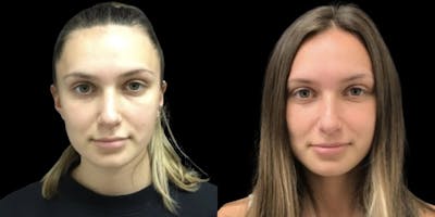 Rhinoplasty Before & After Gallery - Patient 374682 - Image 1