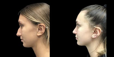 Rhinoplasty Before & After Gallery - Patient 179196 - Image 1