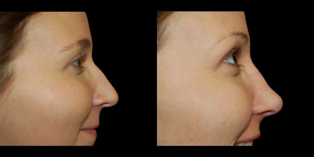 Rhinoplasty Before & After Gallery - Patient 109764 - Image 1