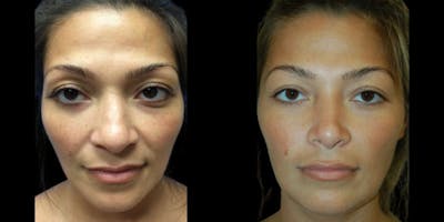 Rhinoplasty Before & After Gallery - Patient 299450 - Image 1