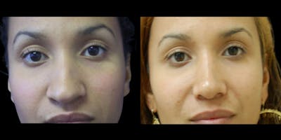 Rhinoplasty Before & After Gallery - Patient 290358 - Image 1