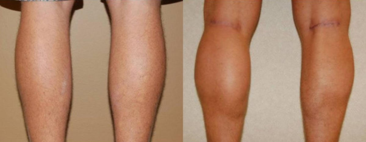 Calf Implants Before & After Gallery - Patient 125727 - Image 1