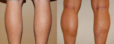 Calf Implants Before & After Gallery - Patient 125727 - Image 1