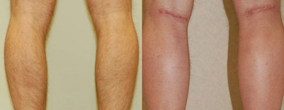 Calf Implants Before & After Gallery - Patient 323427 - Image 1