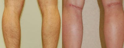 Calf Implants Before & After Gallery - Patient 323427 - Image 1