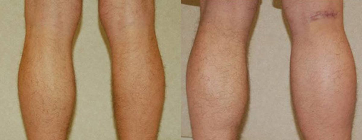 Calf Implants Before & After Gallery - Patient 429171 - Image 1